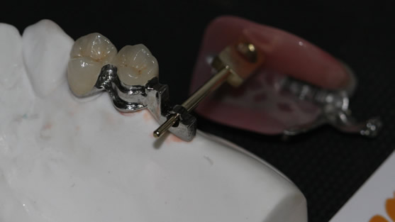 Precision Attachment